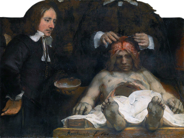 Rembrandt painting of a dissection: a foreshortened corpse lies on a table while Doctor Deyman lifts the scalp to expose the skull; an assistant holds a bowl at left as strong light isolates the operative hands against a dark background.